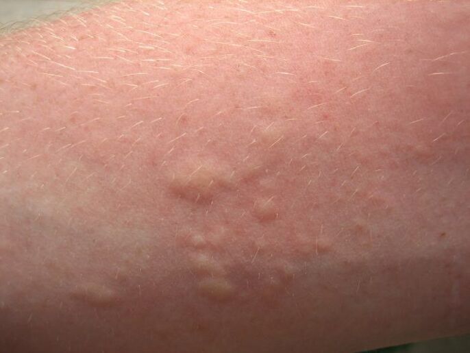 Itchy allergic skin rashes can be symptoms of ascites