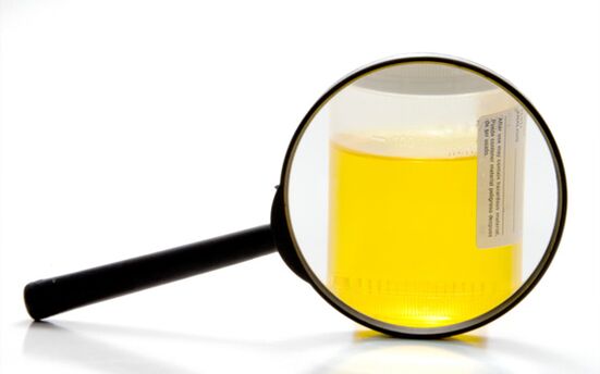 Urine test for the diagnosis of schistosomiasis