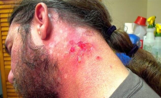 Hemorrhagic wound in the neck with Morgellons virus