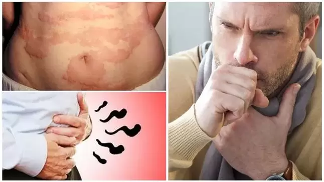 Allergies, coughs and bloating are signs of worm damage to the body. 