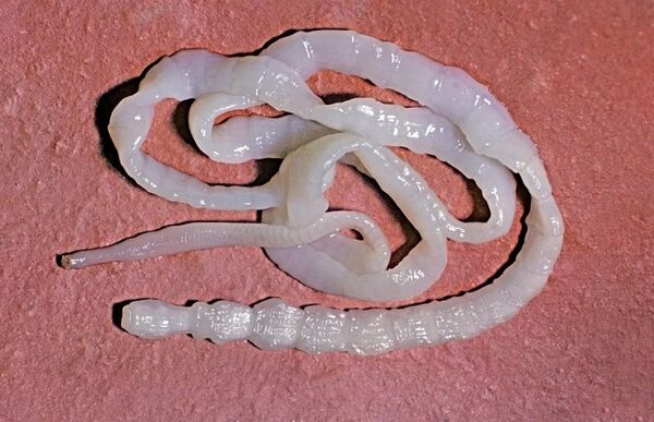 parasitic worm from a child's body